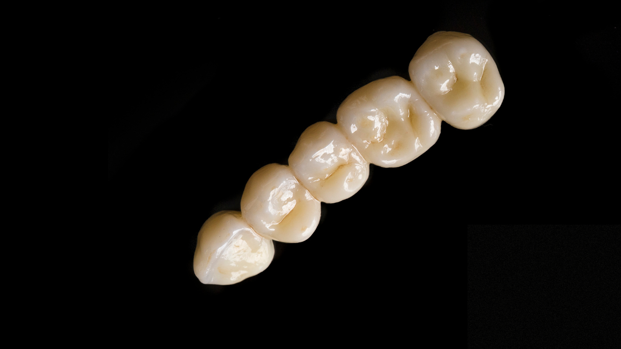 Innovations in Multi-Layer Zirconia: Better Aesthetics with Less Waste